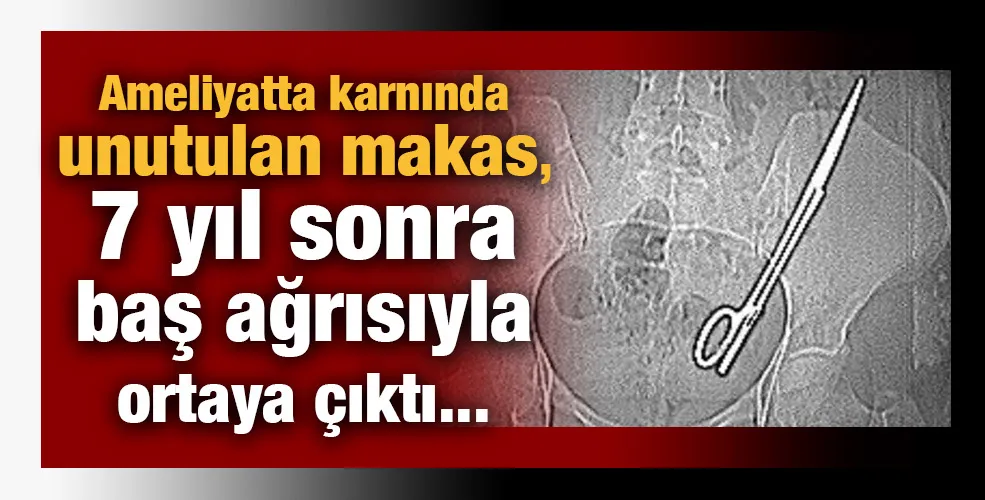 Ameliyatta karnında unutulan makas, 7 yıl sonra baş ağrısıyla ortaya çıktı